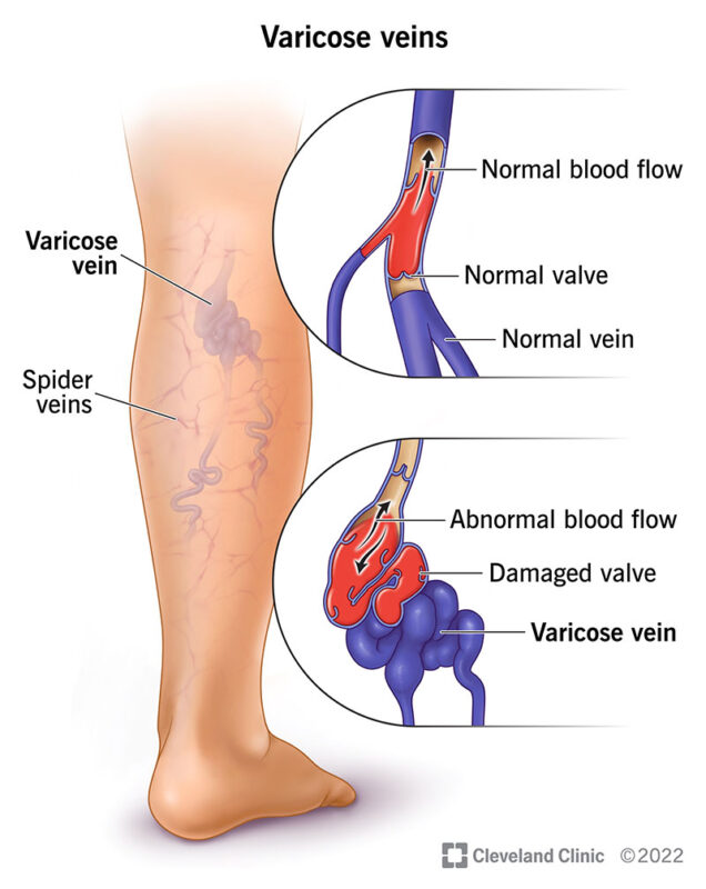 Seurico™ Varicose Veins Cream