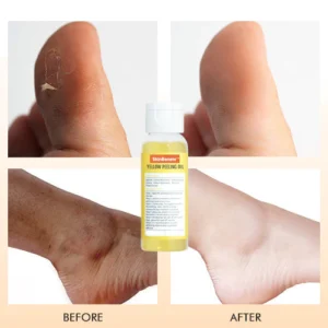 SkinRenew™ Yellow Peeling Oil