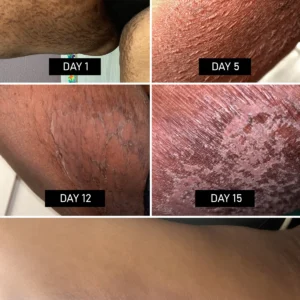 Zakdavi™ Anti-Stretch Mark Black Soap Exfoliator