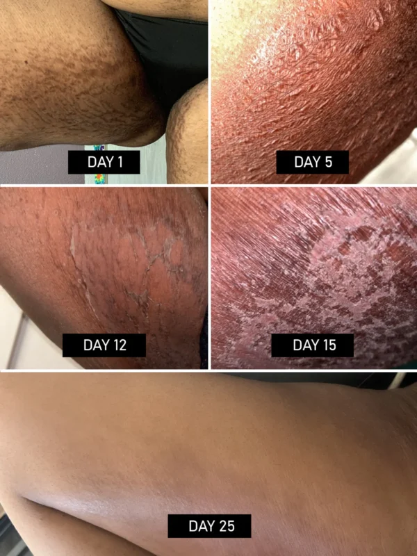 Zakdavi™ Anti-Stretch Mark Black Soap Exfoliator