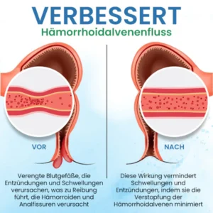 Quezy™ Hämorrhoiden Behandlung Gel