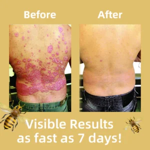 Bee Venom Psoriasis Treatment Cream