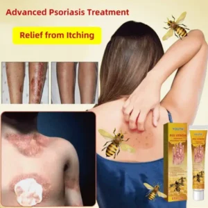 Bee Venom Psoriasis Treatment Cream