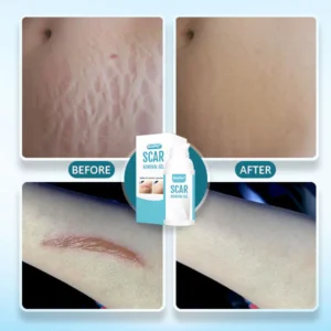 Cuzvc™ Scar Removal Gel