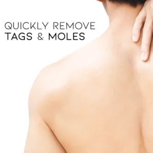 Oveallgo™ Nano-X WipeOff Tags & Moles Remover