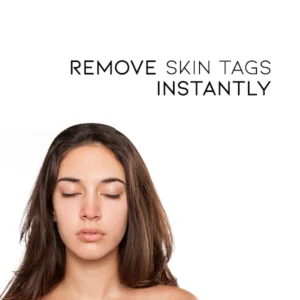 Oveallgo™ Nano-X WipeOff Tags & Moles Remover