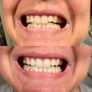 Oveallgo™ Whitening Purple Mousse Toothpaste