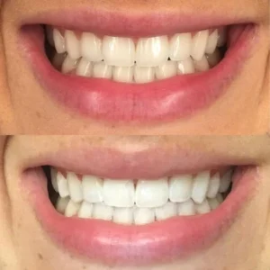 Oveallgo™ Whitening Purple Mousse Toothpaste