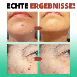 ReYouthBio® Etiketten- und Muttermale-Entferner