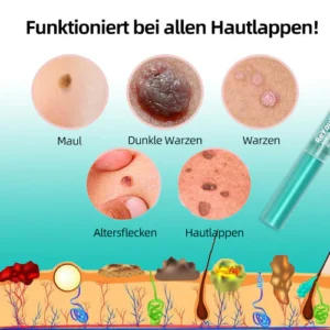 ReYouthBio® Etiketten- und Muttermale-Entferner