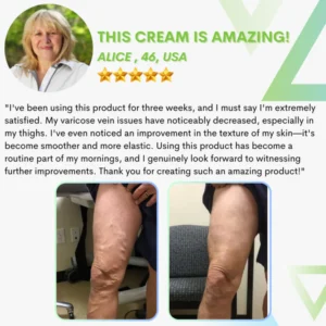 Varicose Vein Repair Cream