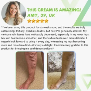 Varicose Vein Repair Cream