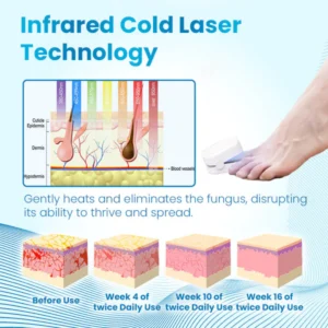 Ceoerty™ Antifungal Light Therapy Toenail Device