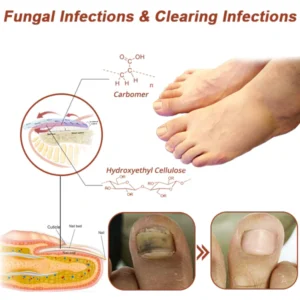 Oveallgo™ Revolutionary PharmaPro High-Efficiency Light Therapy Device For Toenail Diseases