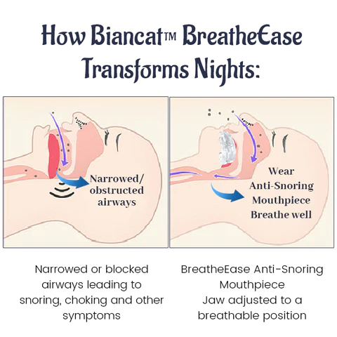 Biancat™ BreatheEase Anti-Snoring Mouthpiece