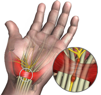 Fivfivgo™ NerveEase Karpaltunnel-Behandlungspflaster