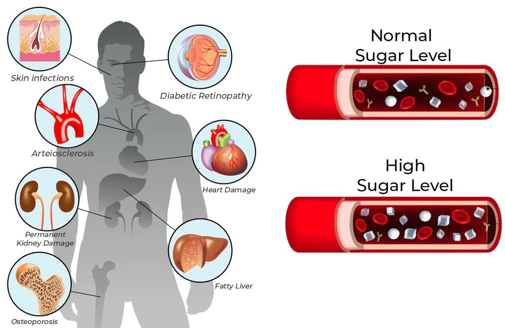 GFOUK™ SugarSync Gesundheit Kontrolle Aerosolizer