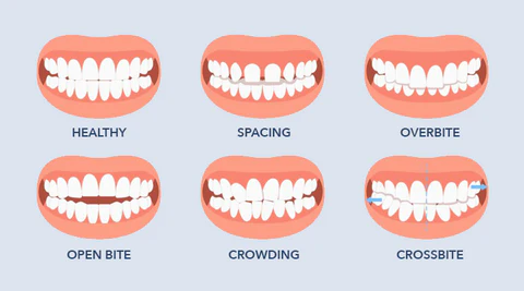 LIMETOW™ Dental Orthodontic Braces
