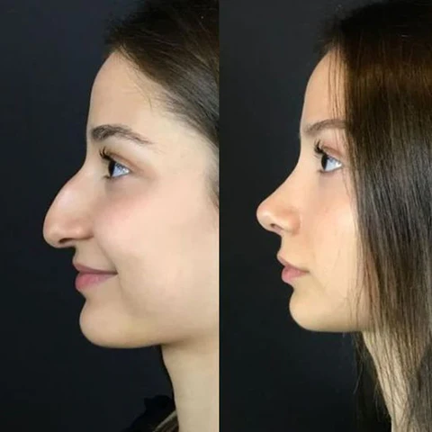 Biancat™ Magic Nose Shaper Device