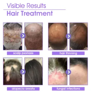 Fivfivgo™ Hair Follicle Repair Hair Growth Drops - Achieve thicker hair quickly