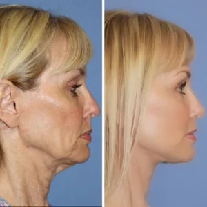 Oveallgo™ UltraRenew Skin Ultrasonic Facelift Device