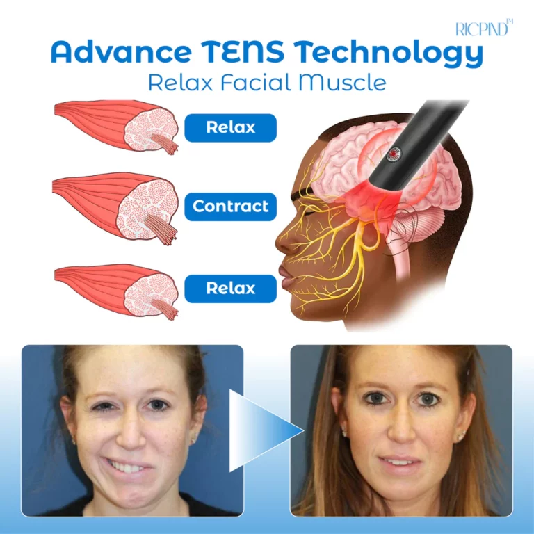 RICPIND Tinnitus NerveTreat InfraredThermal Pen