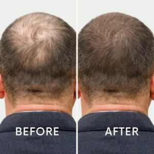 Seurico™ | Laser Cap for Hair Growth