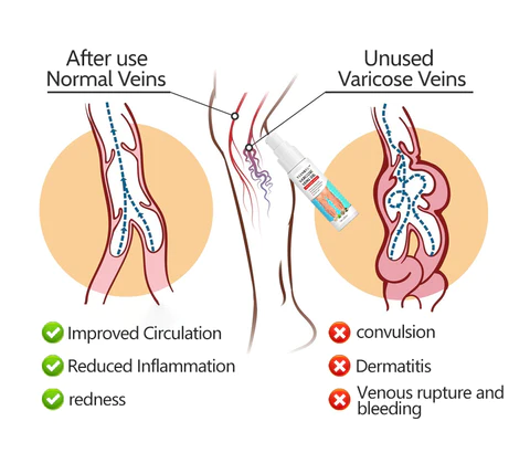 Seurico™ Varicose Veins Gel