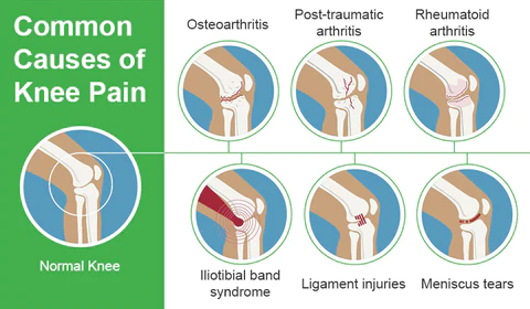 StrongJoints Anti Knee Pain Patch