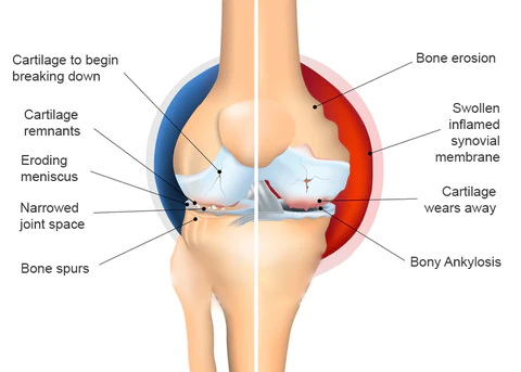 StrongJoints Anti Knee Pain Patch