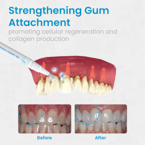 UNPREE™ Gum Shield Therapy Gel