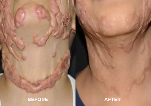 UNPREE™ Silicone Scar Removal Gel