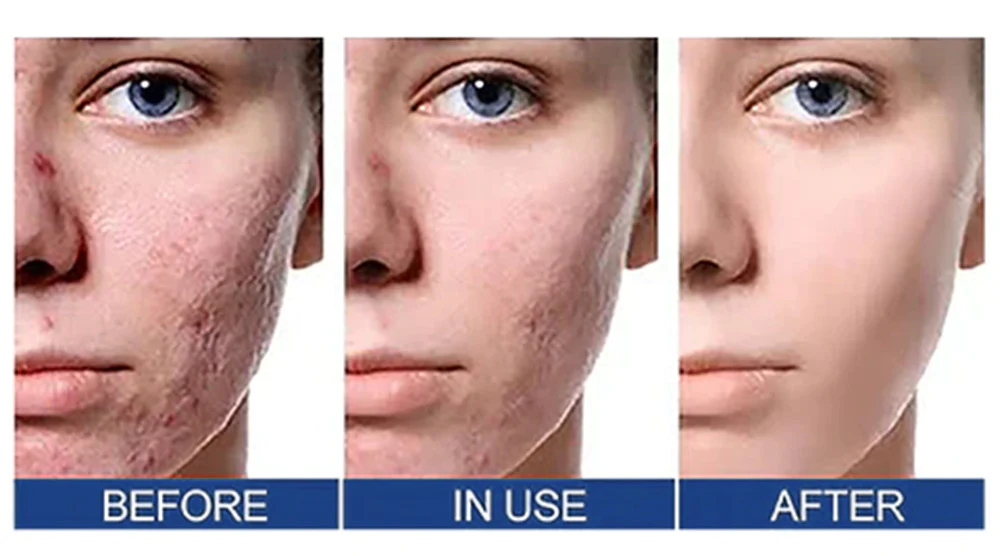 UNPREE™ Silicone Scar Removal Gel