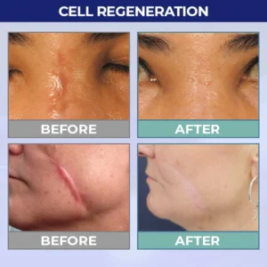 UNPREE™ Silicone Scar Removal Gel