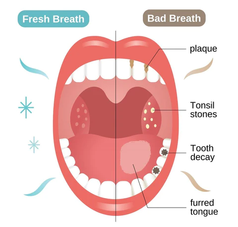 UNPREE™ TEETH Mouthwash - Solve all Oral Problems