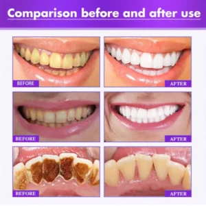 UNPREE™ Teeth Repairing Foam