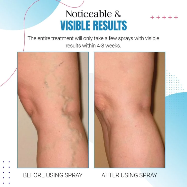 ZAKDAVI™ Varicose Veins Treatment Spray