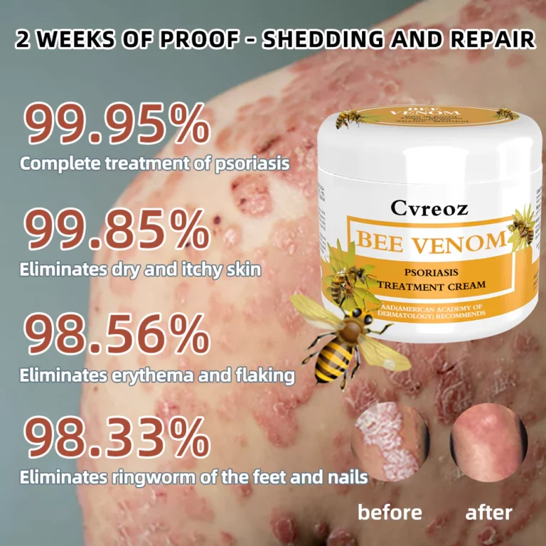 Cvreoz Bee Venom Psoriasis Treatment Cream