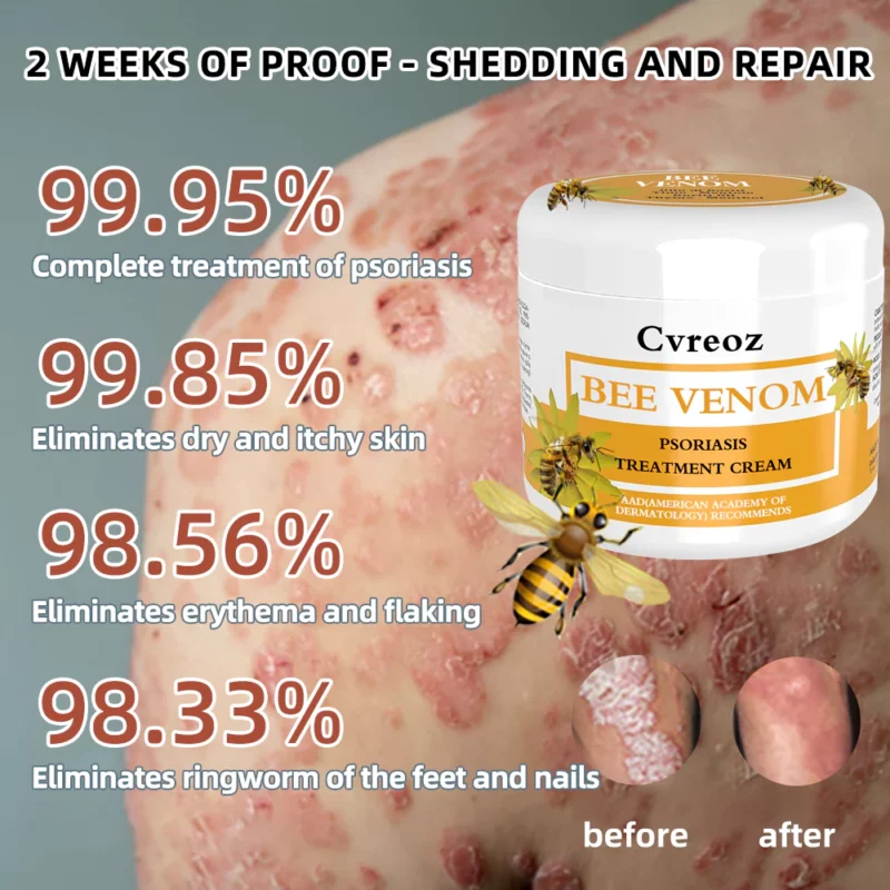 Cvreoz Bee Venom Psoriasis Treatment Cream