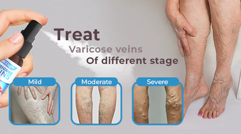 Lovild™ Varicose Veins Spray