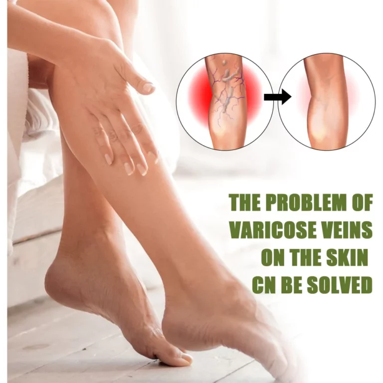 Lovild™ Varicose Veins Spray