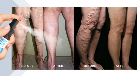 Lovild™ Varicose Veins Spray