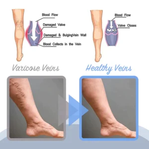 Neslemy™ Varicose Veins Spray