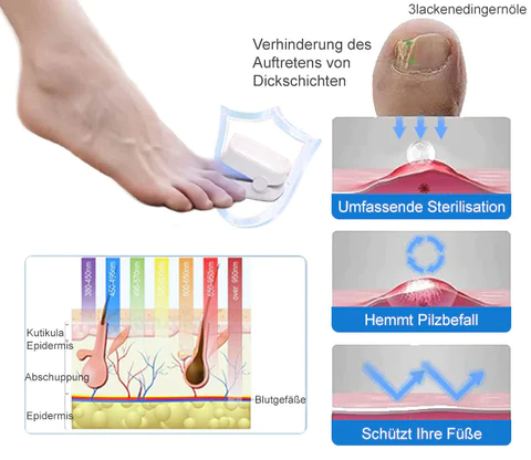 Ourlyard™ Effizientes Lichttherapiegerät zur Behandlung von Nagelerkrankungen