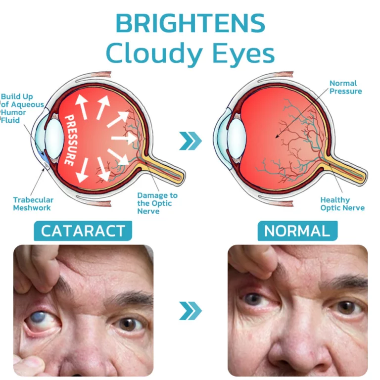 Ourlyard™ FocusHeal Vision Schmiermittel Tränen Augentropfen