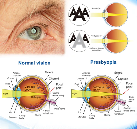 Oveallgo™ OptiVision Eye Disorders Treatment Eye Drops