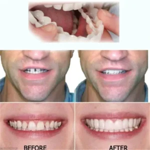 Oveallgo™ SMILE Adjustable Snap-On Dentures