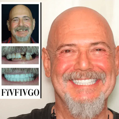 Oveallgo™ SMILE Adjustable Snap-On Dentures