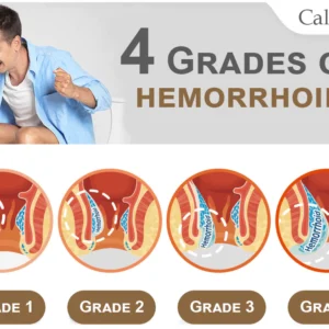 Calmez™ Hemorrhoids Treatment Spray