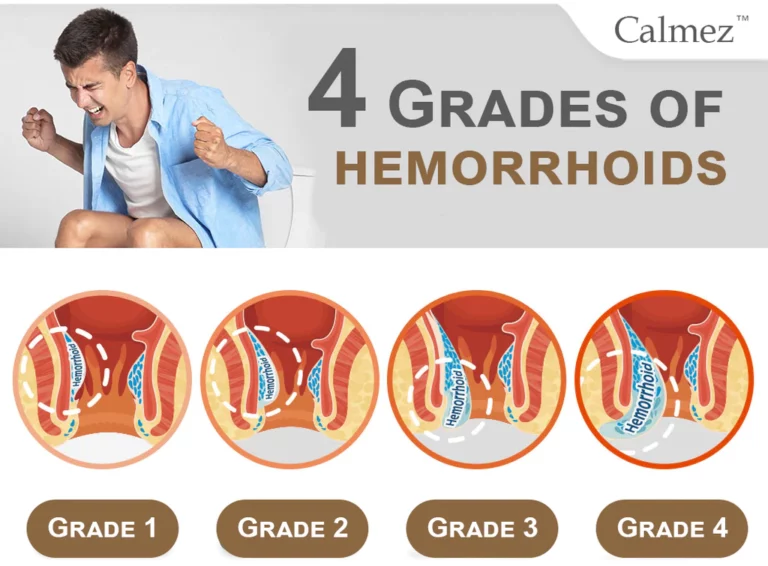 Calmez™ Hemorrhoids Treatment Spray